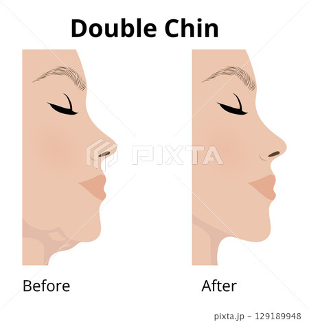 Woman face before and after double chin reduction 129189948