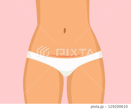 Female Belly with Scar Vector Postpartum Body Concept 129200610