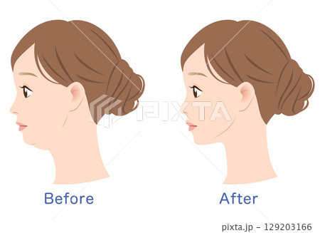 二重あごとスッキリしたあご ビフォーアフター 二重あごとスッキリしたあご ビフォーアフター 129203166