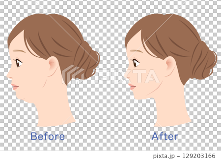 二重あごとスッキリしたあご ビフォーアフター 二重あごとスッキリしたあご ビフォーアフター 129203166