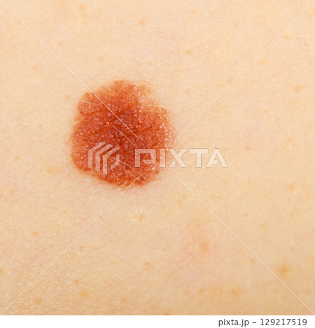 Closeup brown mole on caucasian woman skin. Closeup brown mole on caucasian woman skin. 129217519