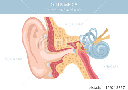 Otitis media. Infection in the middle ear. Otological disorders infographic 129218827