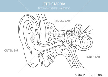Otitis media. Infection in the middle ear. Otological disorders infographic Otitis media. Infection in the middle ear. Otological disorders infographic 129218828