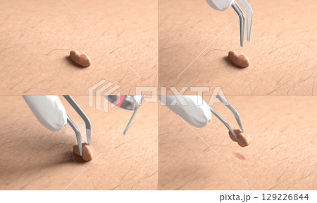 Skin surface with papilloma laser removal treatment process macro 129226844