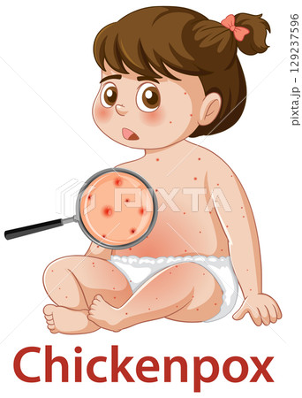 Child with Chickenpox Rash and Magnified Skin Detail 129237596