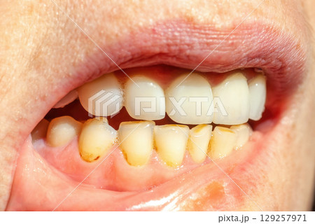 Dental calculus on teeth. Bacterial plaque on smokers teeth 129257971