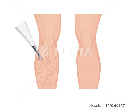 Laser treatment removing varicose veins on patient leg 129260197