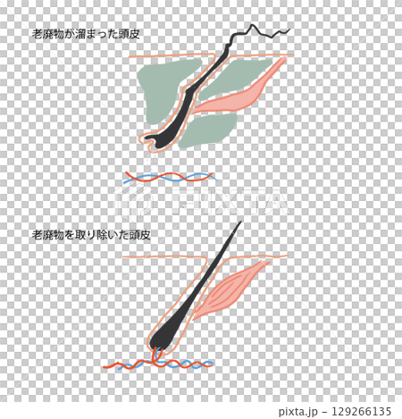 Illustration of a normal scalp and a scalp with accumulated waste products 129266135