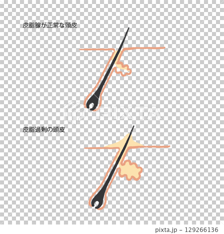 Hand-drawn illustration of hair root and sebum trouble 129266136