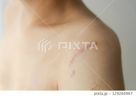 怪我をした男性の肩の傷跡 129268967