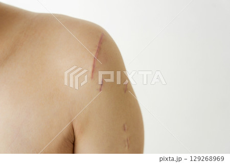 怪我をした男性の肩の傷跡 129268969