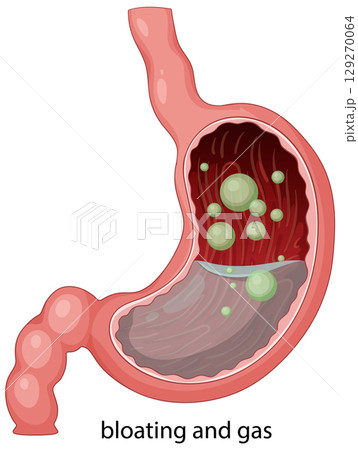 Human Stomach with Gas Bubbles Illustration 129270064