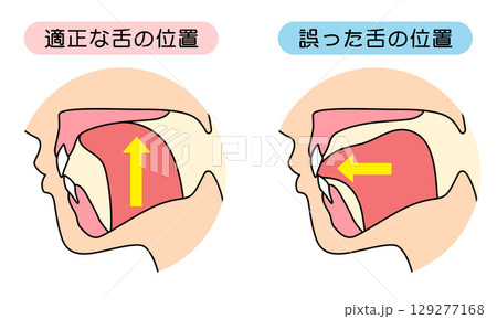 正しいミューイングの方法　適正な舌の位置と誤った舌の位置 129277168