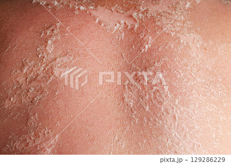 Sunburn on the skin. Skin from the burn texture. Dry skin in need of treatment and hydration. Close up Sunburn on the skin. Skin from the burn texture. Dry skin in need of treatment and hydration. Close up 129286229