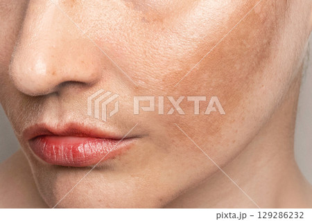 Womans face with pigmentation, melasma, freckles, age spots photo. Close up photo texture 129286232