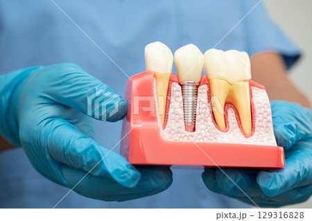 Dental implant, artificial tooth roots into jaw, root canal of dental treatment, gum disease, teeth model for dentist studying about dentistry. 129316828
