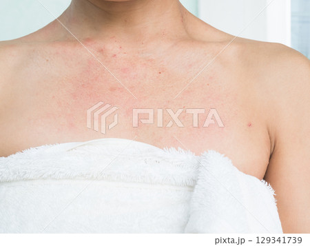 Woman with Urticaria Allergy Itchy Rash Eczema Itch Neck from Food,Air Poisoning,Cosmetic,Health,Body Care Disease Lilness Air,Dissease Medicine Calamine Lotion Treatment ,Infection Pain Sick Scratch. 129341739
