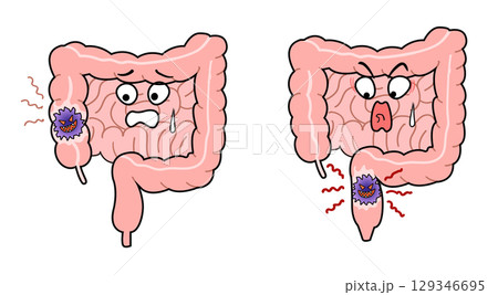 大腸がん 大腸がん 129346695