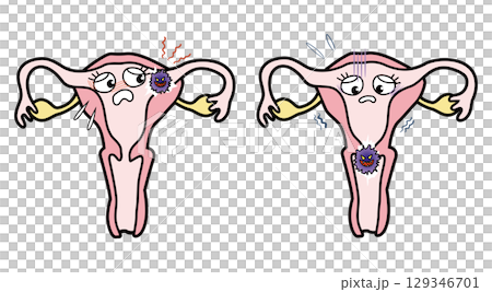 子宮癌 子宮癌 129346701