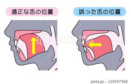 正しいミューイングの方法　適正な舌の位置と誤った舌の位置 129347368