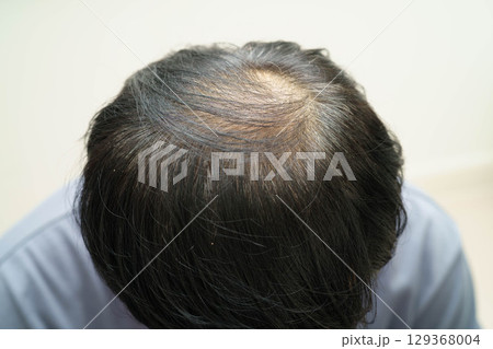 Bald head in man, hair loss treatment health problem. 129368004