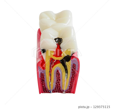 Dental implant, artificial tooth roots into jaw, root canal isolated on white background with clipping path. Dental implant, artificial tooth roots into jaw, root canal isolated on white background with clipping path. 129373115