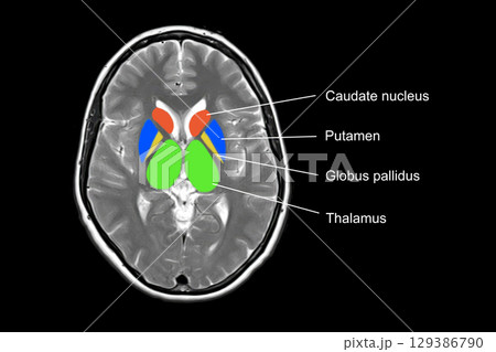 Normal brain anatomy, MRI scan 129386790