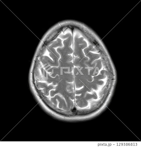 Axial T2-weighted MRI of a 44-year-old patient showing normal brain structures. No visible abnormalities. High signal in CSF and clear cortical sulci 129386813
