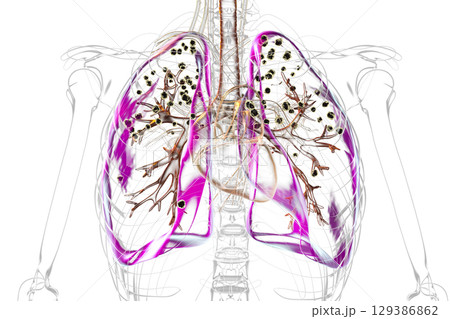 Lungs affected by silicosis, illustration 129386862
