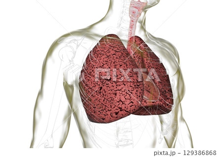 Smoker's lungs, illustration 129386868