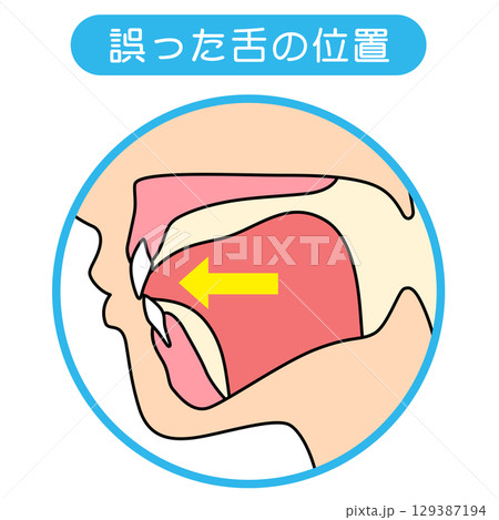 正しいミューイングの方法　適正な舌の位置と誤った舌の位置 129387194