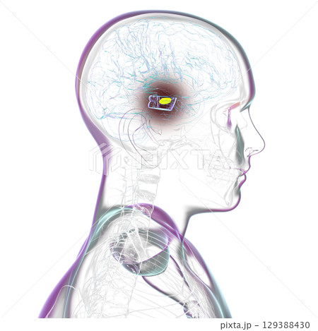 Human brain with degenerated substantia nigra in Parkinson's disease, 3D illustration. 129388430