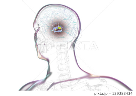 Human brain with degenerated substantia nigra in Parkinson's disease, 3D illustration. 129388434