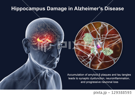 Alzheimer's disease, 3D illustration 129388593