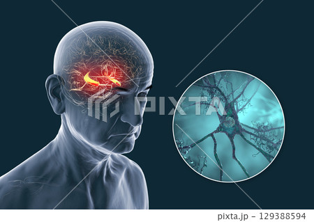 Alzheimer's disease, 3D illustration 129388594