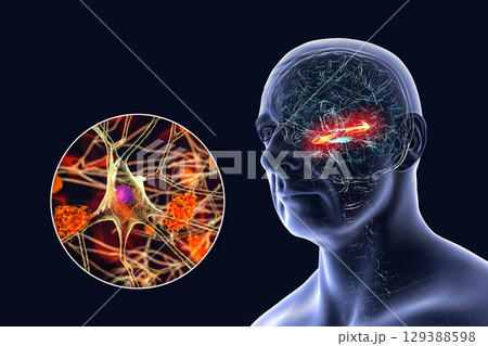 Alzheimer's disease, 3D illustration 129388598