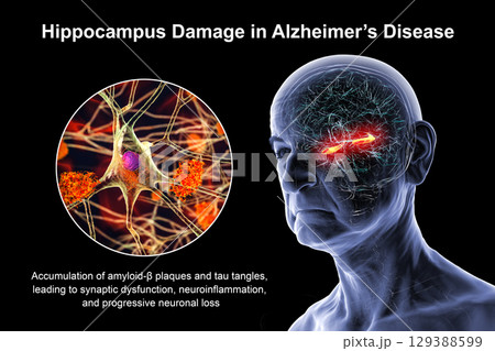 Alzheimer's disease, 3D illustration 129388599