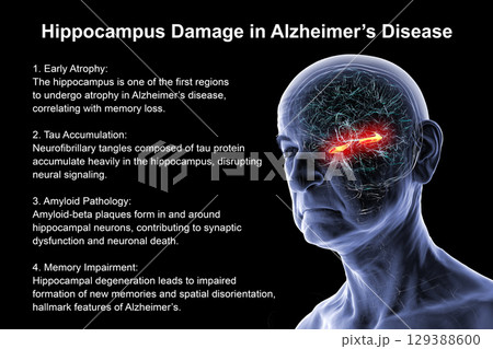Alzheimer's disease, 3D illustration 129388600