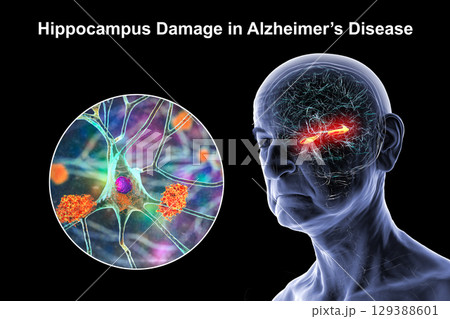 Alzheimer's disease, 3D illustration 129388601