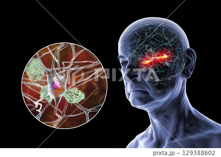 Alzheimer's disease, 3D illustration Alzheimer's disease, 3D illustration 129388602
