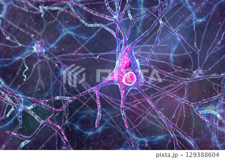 Lewy body dementia, 3D illustration Lewy body dementia, 3D illustration 129388604