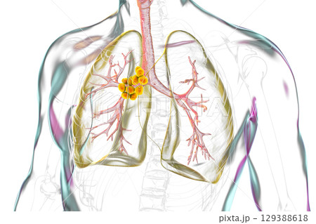 Mediastinal lymphadenitis, illustration Mediastinal lymphadenitis, illustration 129388618