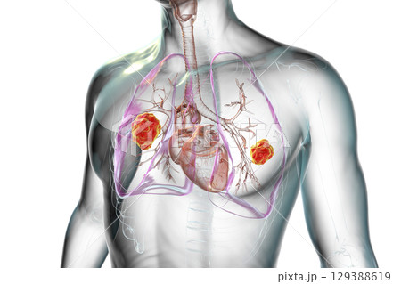 Lung mucormycosis, illustration 129388619