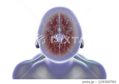Human brain with degenerated substantia nigra in Parkinson's disease, 3D illustration. 129388764
