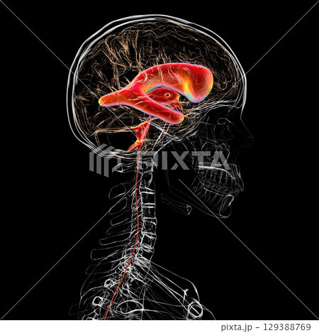 Normal pressure hydrocephalus, 3D illustration 129388769