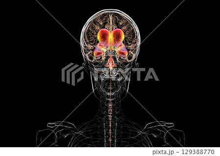 Normal pressure hydrocephalus, 3D illustration 129388770