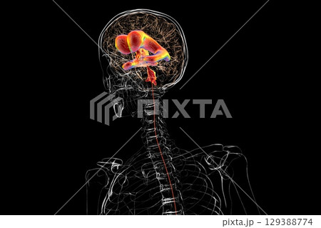 Normal pressure hydrocephalus, 3D illustration Normal pressure hydrocephalus, 3D illustration 129388774
