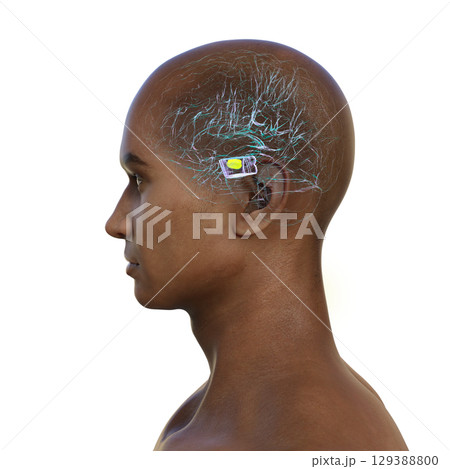 Human brain with degenerated substantia nigra in Parkinson's disease, 3D illustration. 129388800