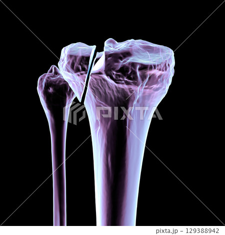 Tibia fracture Schatzker type II, 3D illustration 129388942