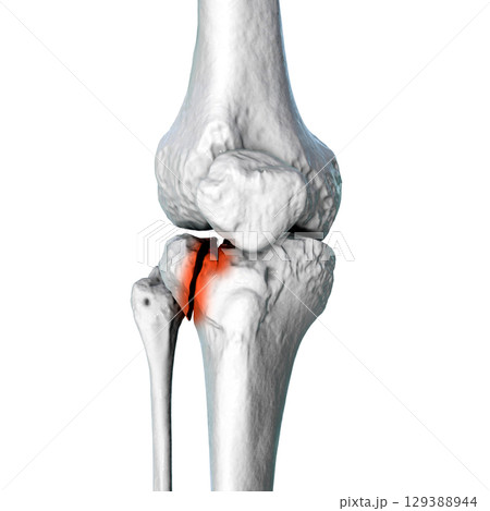 Tibia fracture Schatzker type II, 3D illustration Tibia fracture Schatzker type II, 3D illustration 129388944